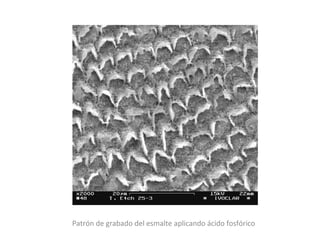 Patrón de grabado del esmalte aplicando ácido fosfórico
 