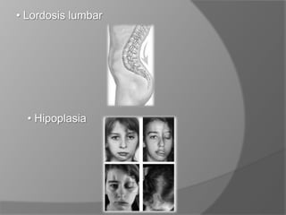  Limitación de extensión del codo