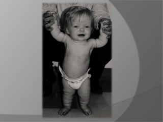 HipoplasiaPiernas arqueadas y cortas