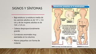 SIGNOS Y SÍNTOMAS
• Baja estatura: La estatura media de
los varones adultos es de 131 ± 5.6
cm y de las mujeres adultas es de
124 ± 5.9 cm.
• Cabeza desproporcionalmente
grande
• Curvaturas anormales muy
asentadas en la columna
• Manos pequeñas con forma de
tridente
 