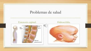 Problemas de salud
Estenosis espinal. Hidrocefalia.
 
