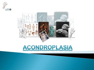 Seminario de Acondroplasia