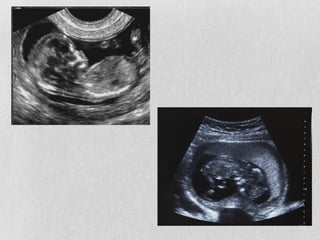 Aconselhamento Genético