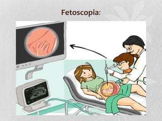 Fetoscopia:

 
