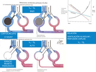 RELACIÓN
VENTILACIÓN ALVEOLAR /
PERFUSIÓN CAPILAR:
VA / QC
1
2
ESPACIO
MUERTO
FISIOLÓGICO
VA / QC
BAJO
VA / QC
ALTO
CORTOCIRCUITO O SHUNT
CORTOCIRCUITO
O SHUNT
 