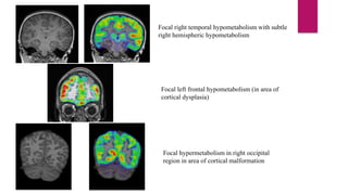 PET/SPECT in Epilepsy Surgery | PPTX