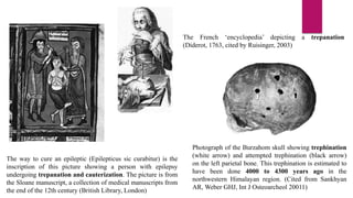 PET/SPECT in Epilepsy Surgery | PPTX