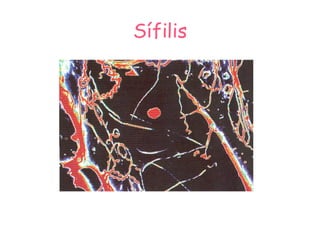 Sífilis 