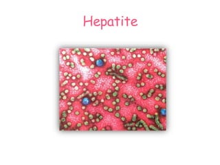 Hepatite 