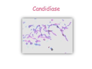 Candidíase 