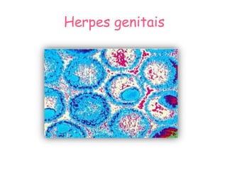 Herpes genitais 