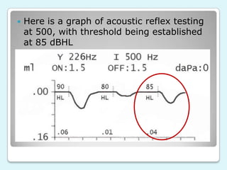

Here is a graph of acoustic reflex testing
at 500, with threshold being established
at 85 dBHL

 