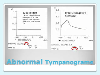 Type B=flat

*Note: based on the
enlarged ECV, this
patient has a patent
tube or a hole in the
TM

Type C=negative
pressure

Abnormal Tympanograms

 