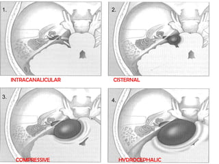 1. 2.
3.
4.
INTRACANALICULAR CISTERNAL
COMPRESSIVE HYDROCEPHALIC
 