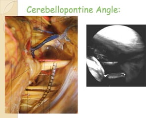 Cerebellopontine Angle:
 