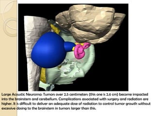 Large Acoustic Neuroma: Tumors over 2.5 centimeters (this one is 2.6 cm) become impacted
into the brainstem and cerebellum. Complications associated with surgery and radiation are
higher. It is difficult to deliver an adequate dose of radiation to control tumor growth without
excessive dosing to the brainstem in tumors larger than this.
 