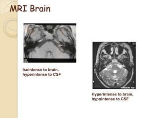 MRI Brain
Isointense to brain,
hyperintense to CSF
Hyperintense to brain,
hypointense to CSF
 