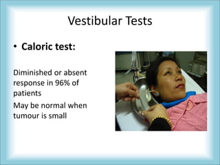 Normal Caloric Test Acoustic neuroma | PPTX