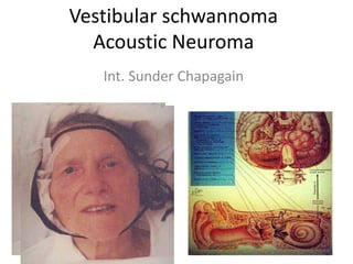 Vestibular schwannoma
Acoustic Neuroma
Int. Sunder Chapagain
 