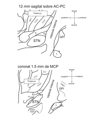 12 mm sagital sobre AC-PC
   Zi.c                                                                              dorsal
                     Thalamus
                                                        Rf            posterior                   anterior




                .i
            Vim


                       o.p
   V.c.i




                                          o.a




                                                             na
                     V.



                                          V.




                                                             nter
                                                                                     ventral




                                                        ula i
                       Zi




                                                   caps
                                           H2
                                                                     GPi
                     STN


                                                                II




coronal 1.5 mm de MCP
                                                                                  dorsal
                                           Z.o

                            .i                                                                 lateral
                      V.a                                             medial
                                                        na




           Thalamus
                                                                     La           ventral
                                                    nter




                                     .a                                   pm
                                 V.o

                                                                     GPi
                                                  ula i




                             Zi
                                                 caps




                                  H2
           H1+2


                     STN
                                                               II

              Subst.
              nigra
 