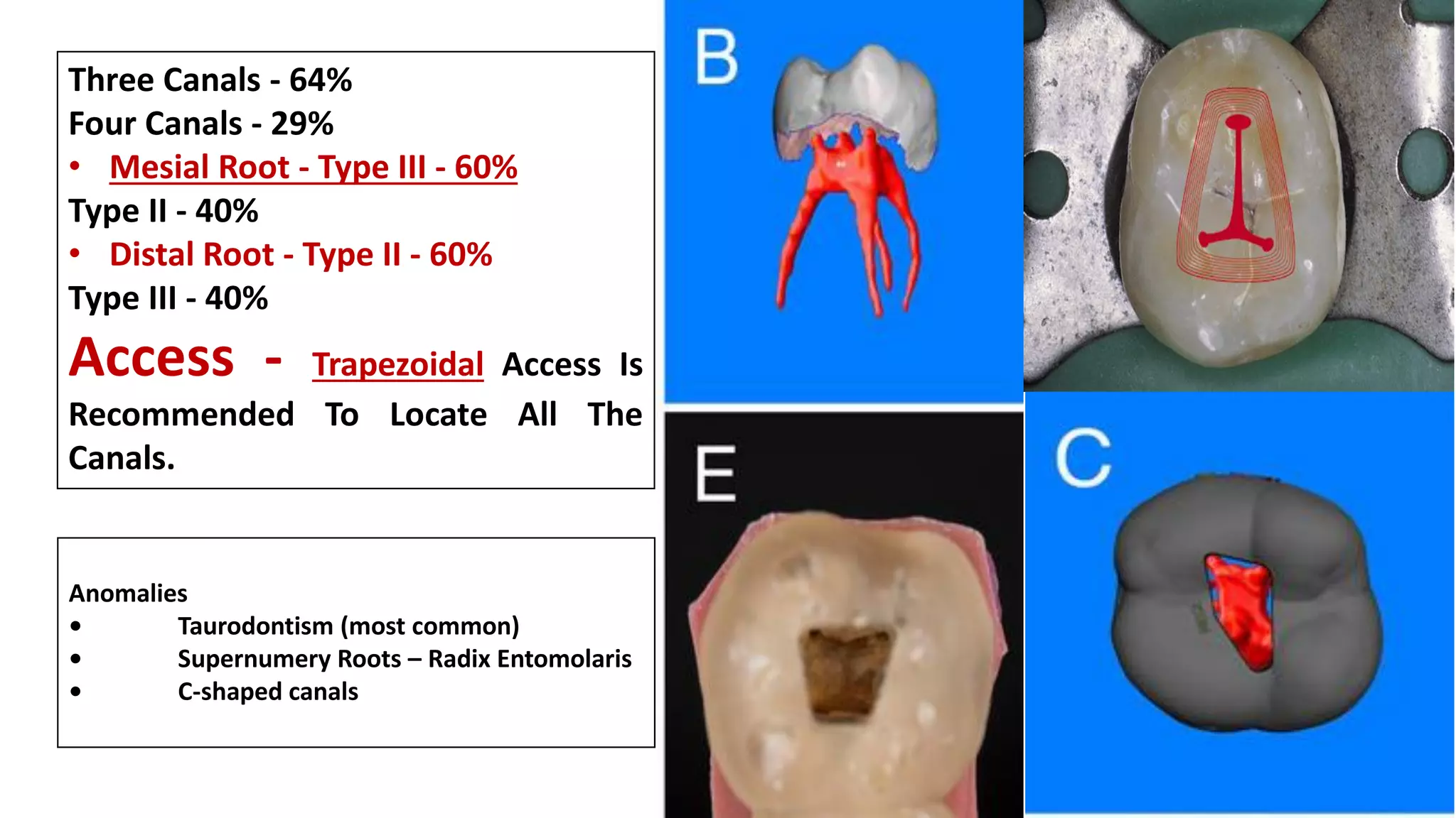 Three Canals - 64%
Four Canals - 29%
• Mesial Root - Type III - 60%
Type II - 40%
• Distal Root - Type II - 60%
Type III - 40%
Access - Trapezoidal Access Is
Recommended To Locate All The
Canals.
Anomalies
• Taurodontism (most common)
• Supernumery Roots – Radix Entomolaris
• C-shaped canals
 