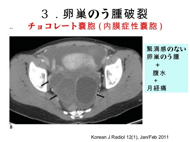 急性の女性腹痛アプローチ 急性の女性腹痛アプローチ
