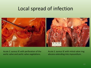 Local spread of infection




Acute S. aureus IE with perforation of the   Acute S. aureus IE with mitral valve ring
aortic valve and aortic valve vegetations.   abscess extending into myocardium.



                                                                                    102
 