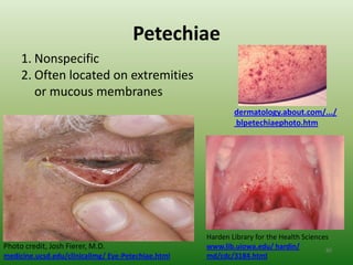 Petechiae
     1. Nonspecific
     2. Often located on extremities
        or mucous membranes
                                                            dermatology.about.com/.../
                                                            blpetechiaephoto.htm




                                                    Harden Library for the Health Sciences
Photo credit, Josh Fierer, M.D.                     www.lib.uiowa.edu/ hardin/           80
medicine.ucsd.edu/clinicalimg/ Eye-Petechiae.html   md/cdc/3184.html
 