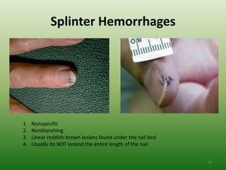 Splinter Hemorrhages




1.   Nonspecific
2.   Nonblanching
3.   Linear reddish-brown lesions found under the nail bed
4.   Usually do NOT extend the entire length of the nail


                                                             81
 