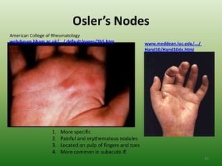 Osler’s Nodes
American College of Rheumatology
webrheum.bham.ac.uk/.../ default/pages/3b5.htm               www.meddean.luc.edu/.../
                                                             Hand10/Hand10dx.html




                  1.   More specific
                  2.   Painful and erythematous nodules
                  3.   Located on pulp of fingers and toes
                  4.   More common in subacute IE
                                                                                        82
 