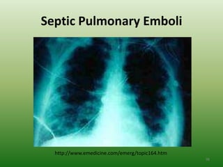 Septic Pulmonary Emboli




  http://www.emedicine.com/emerg/topic164.htm
                                                98
 