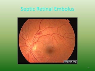 Septic Retinal Embolus




                         99
 
