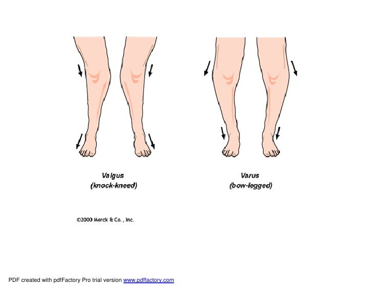 Acquired Bone Deformities