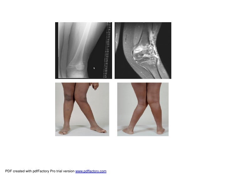 Acquired Bone Deformities