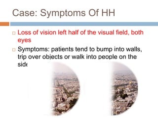 Half Vision