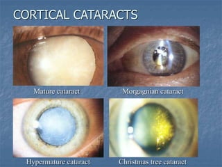 CORTICAL CATARACTS
Mature cataract Morgagnian cataract
Hypermature cataract Christmas tree cataract
 