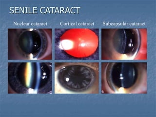 Nuclear cataract Cortical cataract Subcapsular cataract
SENILE CATARACT
 
