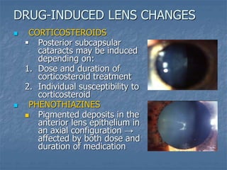  CORTICOSTEROIDS
 Posterior subcapsular
cataracts may be induced
depending on:
1. Dose and duration of
corticosteroid treatment
2. Individual susceptibility to
corticosteroid
 PHENOTHIAZINES
 Pigmented deposits in the
anterior lens epithelium in
an axial configuration →
affected by both dose and
duration of medication
DRUG-INDUCED LENS CHANGES
 