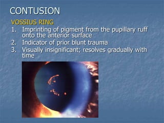 VOSSIUS RING
1. Imprinting of pigment from the pupillary ruff
onto the anterior surface
2. Indicator of prior blunt trauma
3. Visually insignificant; resolves gradually with
time
CONTUSION
 