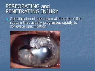  Opacification of the cortex at the site of the
rupture that usually progresses rapidly to
complete opacification
PERFORATING and
PENETRATING INJURY
 