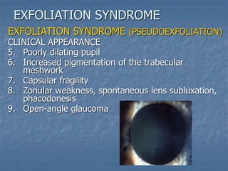 EXFOLIATION SYNDROME (PSEUDOEXFOLIATION)
CLINICAL APPEARANCE
5. Poorly dilating pupil
6. Increased pigmentation of the trabecular
meshwork
7. Capsular fragility
8. Zonular weakness, spontaneous lens subluxation,
phacodonesis
9. Open-angle glaucoma
EXFOLIATION SYNDROME
 