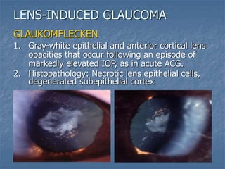 GLAUKOMFLECKEN
1. Gray-white epithelial and anterior cortical lens
opacities that occur following an episode of
markedly elevated IOP, as in acute ACG.
2. Histopathology: Necrotic lens epithelial cells,
degenerated subepithelial cortex
LENS-INDUCED GLAUCOMA
 