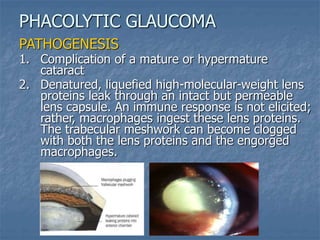 PATHOGENESIS
1. Complication of a mature or hypermature
cataract
2. Denatured, liquefied high-molecular-weight lens
proteins leak through an intact but permeable
lens capsule. An immune response is not elicited;
rather, macrophages ingest these lens proteins.
The trabecular meshwork can become clogged
with both the lens proteins and the engorged
macrophages.
PHACOLYTIC GLAUCOMA
 