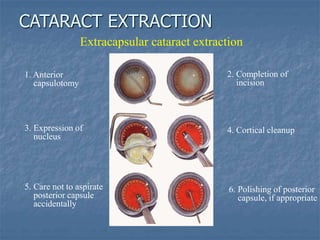 1. Anterior
capsulotomy
3. Expression of
nucleus
5. Care not to aspirate
posterior capsule
accidentally
2. Completion of
incision
4. Cortical cleanup
6. Polishing of posterior
capsule, if appropriate
Extracapsular cataract extraction
CATARACT EXTRACTION
 