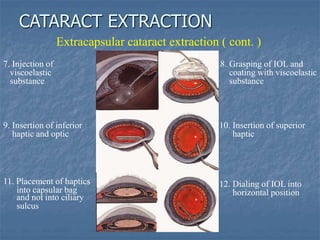 Extracapsular cataract extraction ( cont. )
7. Injection of
viscoelastic
substance
9. Insertion of inferior
haptic and optic
11. Placement of haptics
into capsular bag
and not into ciliary
sulcus
8. Grasping of IOL and
coating with viscoelastic
substance
10. Insertion of superior
haptic
12. Dialing of IOL into
horizontal position
CATARACT EXTRACTION
 