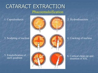 Phacoemulsification
1. Capsulorrhexis
3. Sculpting of nucleus
5. Emulsification of
each quadrant
2. Hydrodissection
4. Cracking of nucleus
6. Cortical clean-up and
insertion of IOL
CATARACT EXTRACTION
 