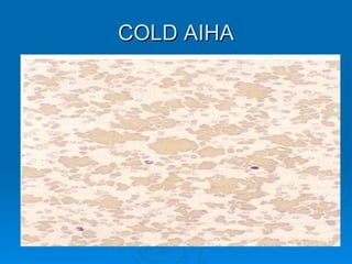 Acquired hemolytic anemia | PPT