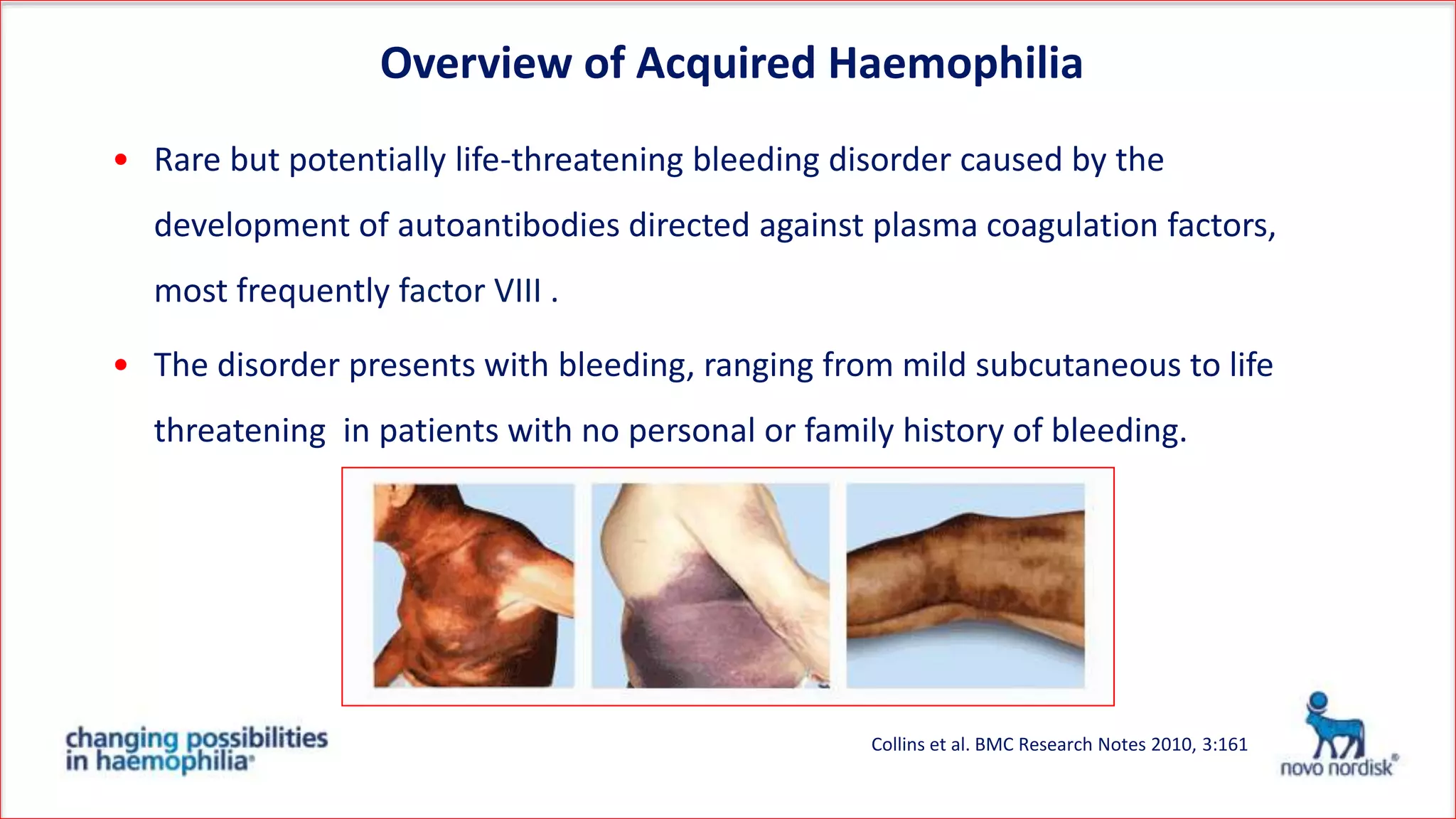 Overview of Acquired Haemophilia
• Rare but potentially life-threatening bleeding disorder caused by the
development of autoantibodies directed against plasma coagulation
factors, most frequently factor VIII .
• The disorder presents with bleeding, ranging from mild subcutaneous to life
threatening in patients with no personal or family history of bleeding.
Collins et al. BMC Research Notes 2010, 3:161
 