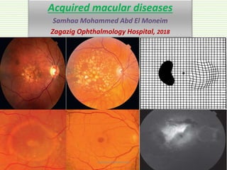 Acquired macular diseases
Samhaa Mohammed Abd El Moneim
Zagazig Ophthalmology Hospital, 2018
Samhaa Mohammed
 