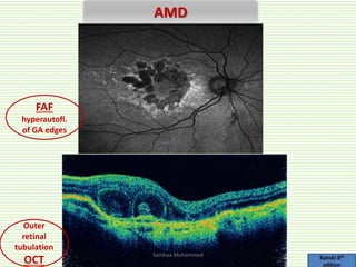 Acquired macular diseases | PPTX